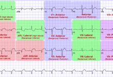 leads ecg placement