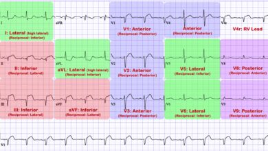 leads ecg placement